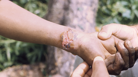 Leishmaniasis. Credit: CDC 